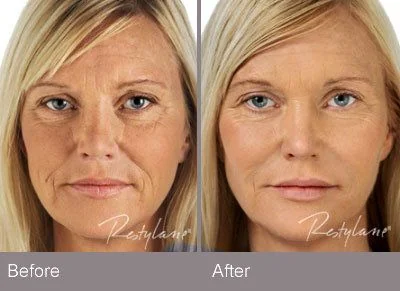 Before and After – Restylane​